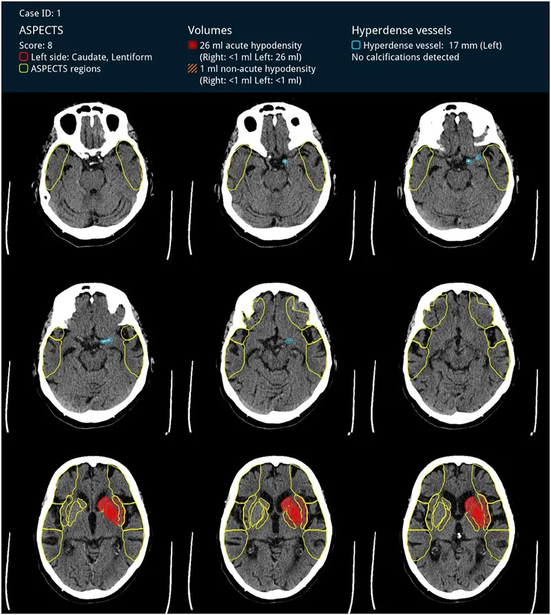 NCCT Head: Hyperdense MCA sign, early ischemic changes