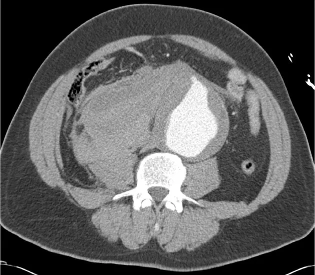 Ruptured AAA with retroperitoneal hematoma and extravasation