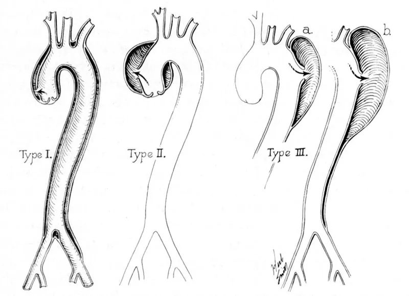 DeBakey Classification of Aortic Dissection