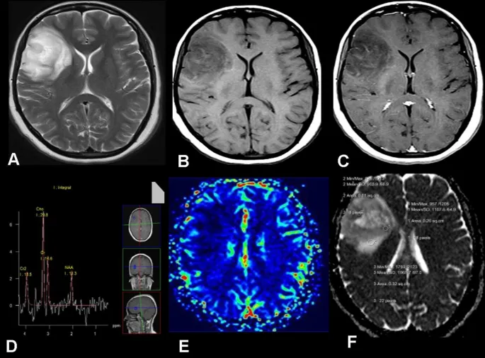 Axial rCBV map of high-grade glioma