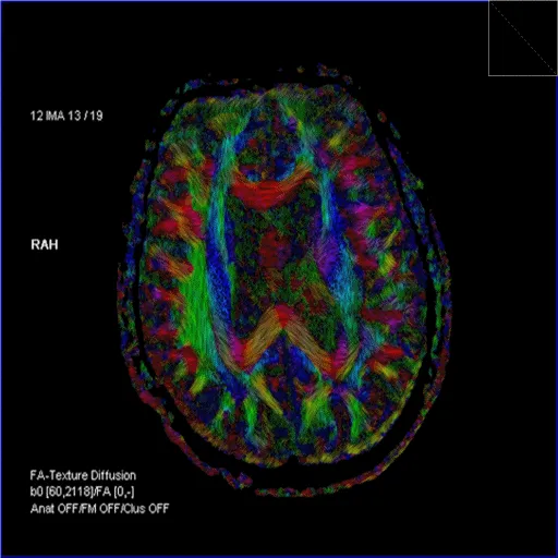 DTI tractography with FA color map