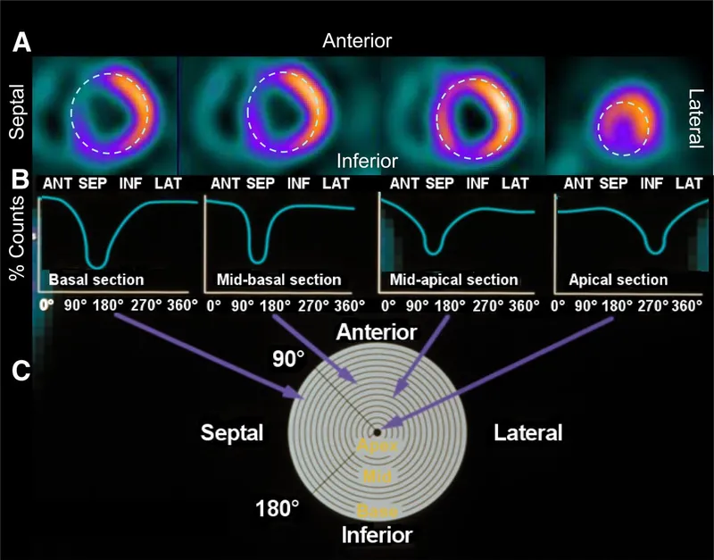 Cardiac SPECT Myocardial Perfusion Bullseye Plot