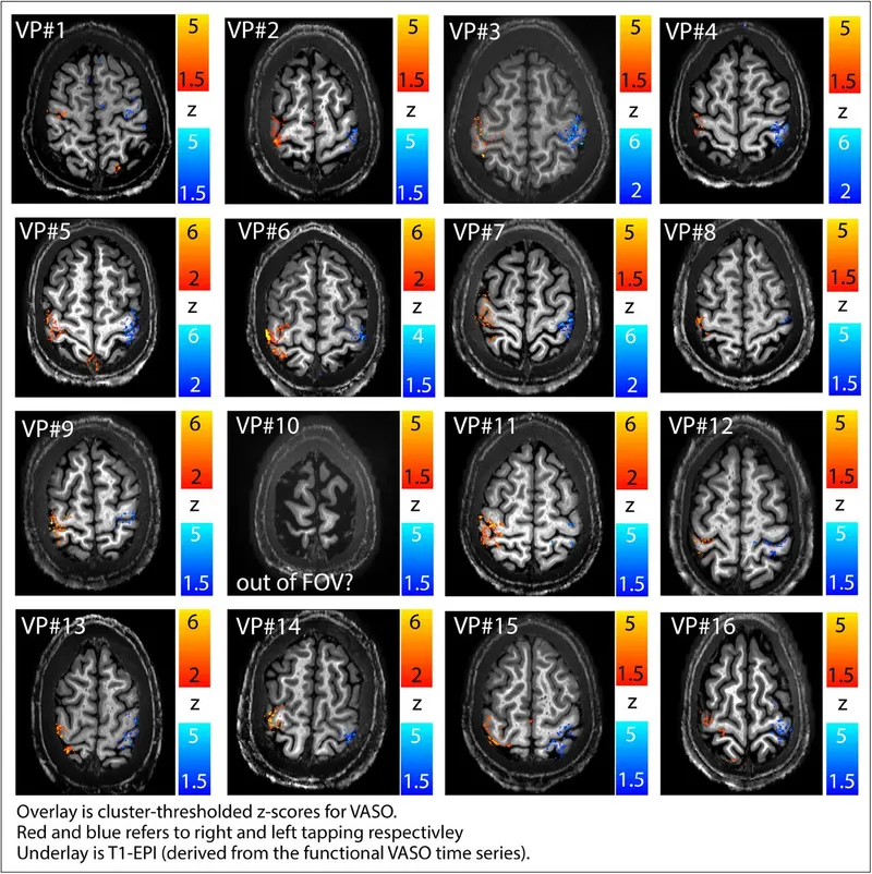 fMRI activation maps for hand tapping