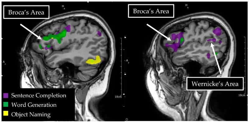 fMRI Language Mapping: Broca's and Wernicke's Areas