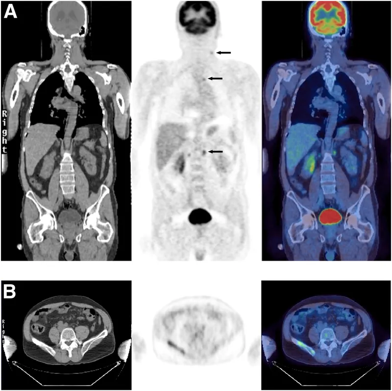 FDG PET-CT scan showing lymphoma staging