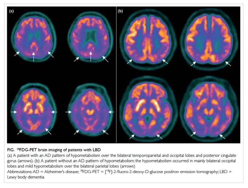 18FDG-PET brain imaging in Alzheimer's vs Lewy body dementia