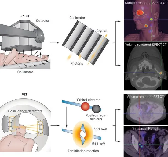 SPECT vs PET detection methods and resulting images