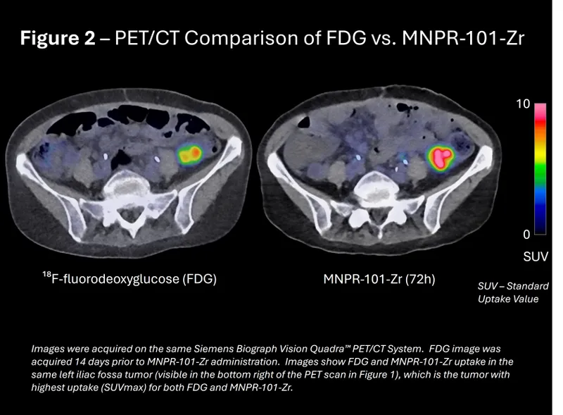 FDG vs. MNPR-101-Zr PET/CT tumor SUV comparison