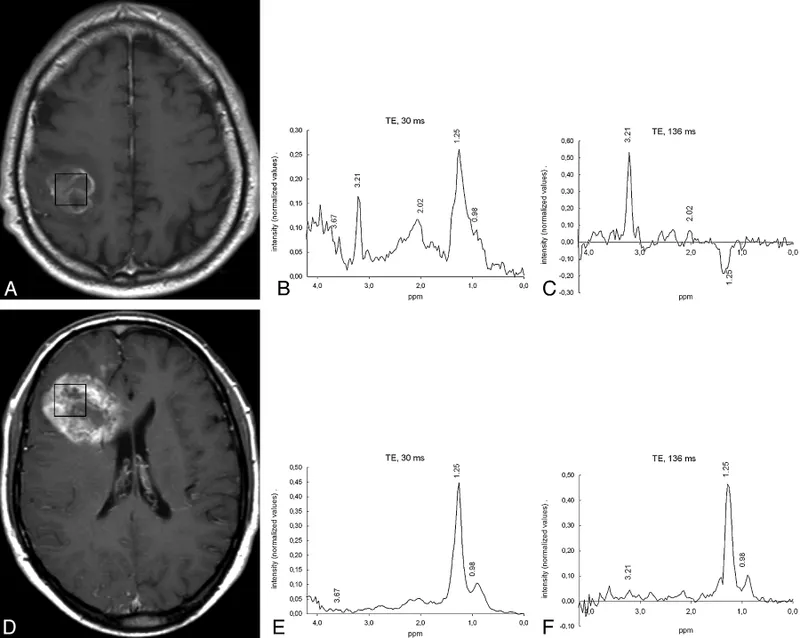 MRS spectra: Brain tumor vs. radiation necrosis