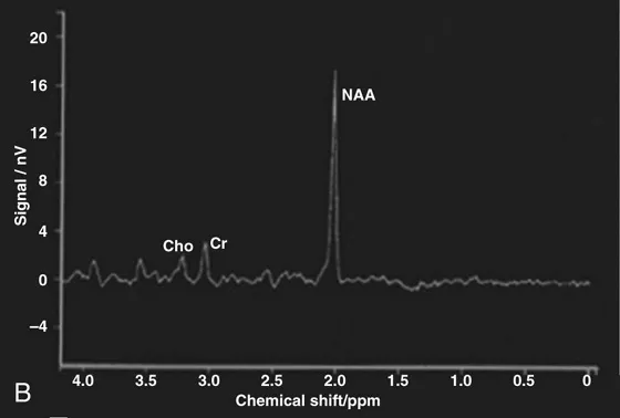 MRS spectrum with NAA, Cho, and Cr peaks