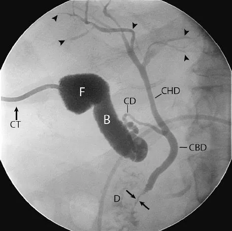 Percutaneous transhepatic cholangiogram