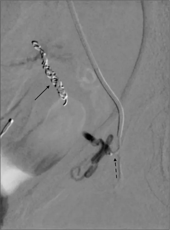Angiogram: Embolization of bleeding artery with coils