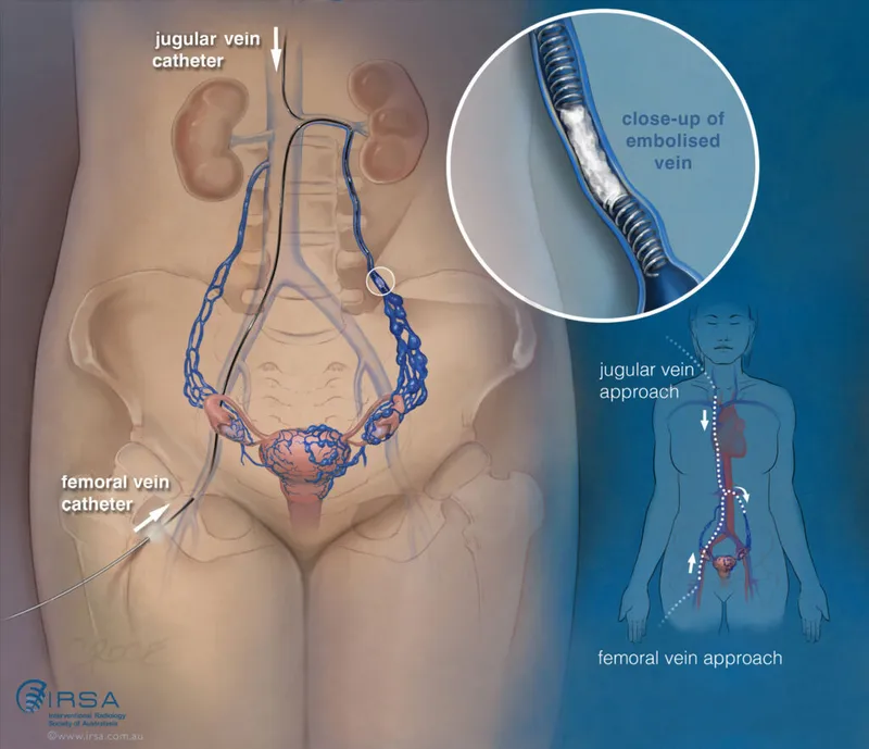 Pelvic vein embolization approaches