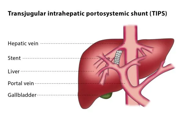 Diagram of TIPS stent connecting portal and hepatic veins