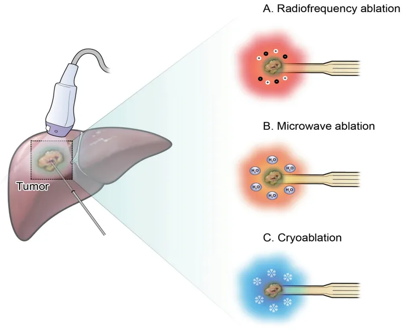 Tumor Ablation Techniques