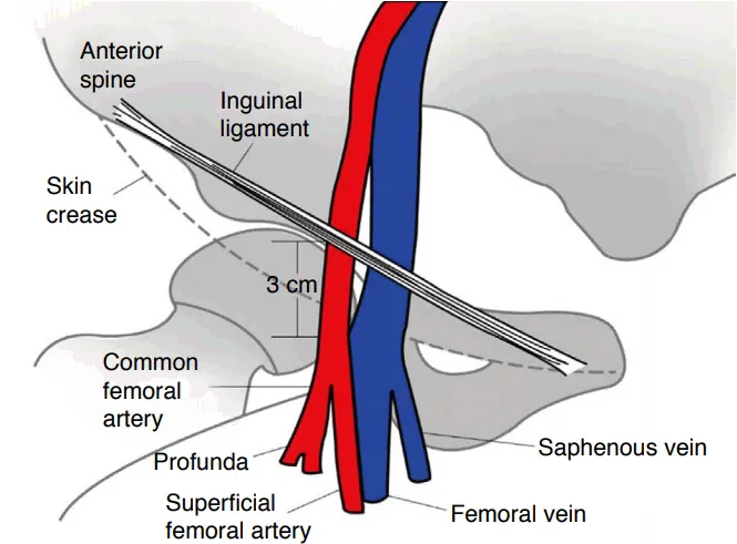 Femoral Artery Access & Complications