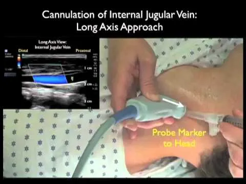 IJV Cannulation: Long Axis Ultrasound