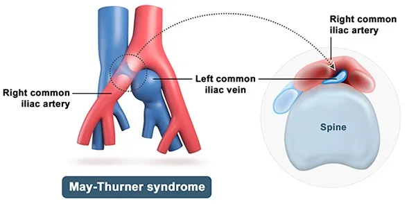 May-Thurner syndrome anatomical illustration
