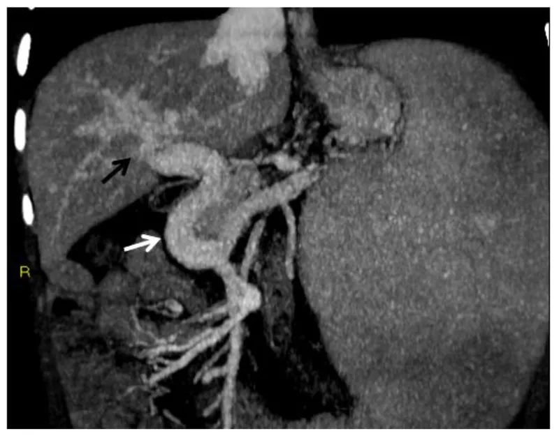 Coronal CT of patent TIPS stent