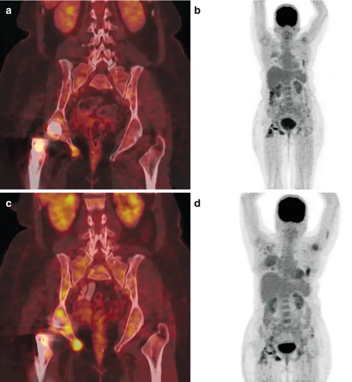 FDG PET/CT of prosthetic joint infection