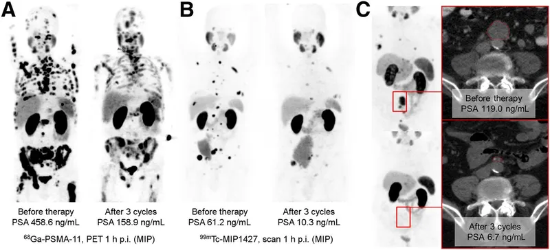 PSMA PET/CT before and after Lu-177 PSMA therapy