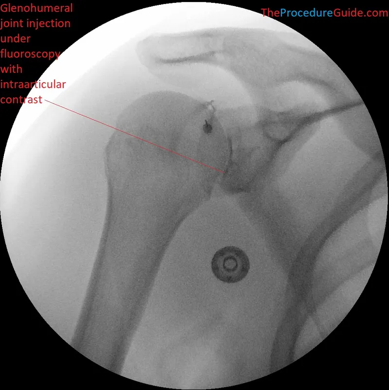 Glenohumeral joint injection under fluoroscopy
