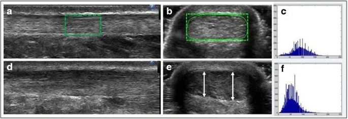 Achilles Tendinopathy Ultrasound Views