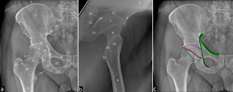 Radiographic Anatomy of the Hip Joint
