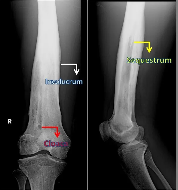 Chronic osteomyelitis: sequestrum, involucrum, cloaca