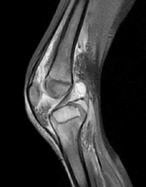 MRI of septic arthritis of the knee