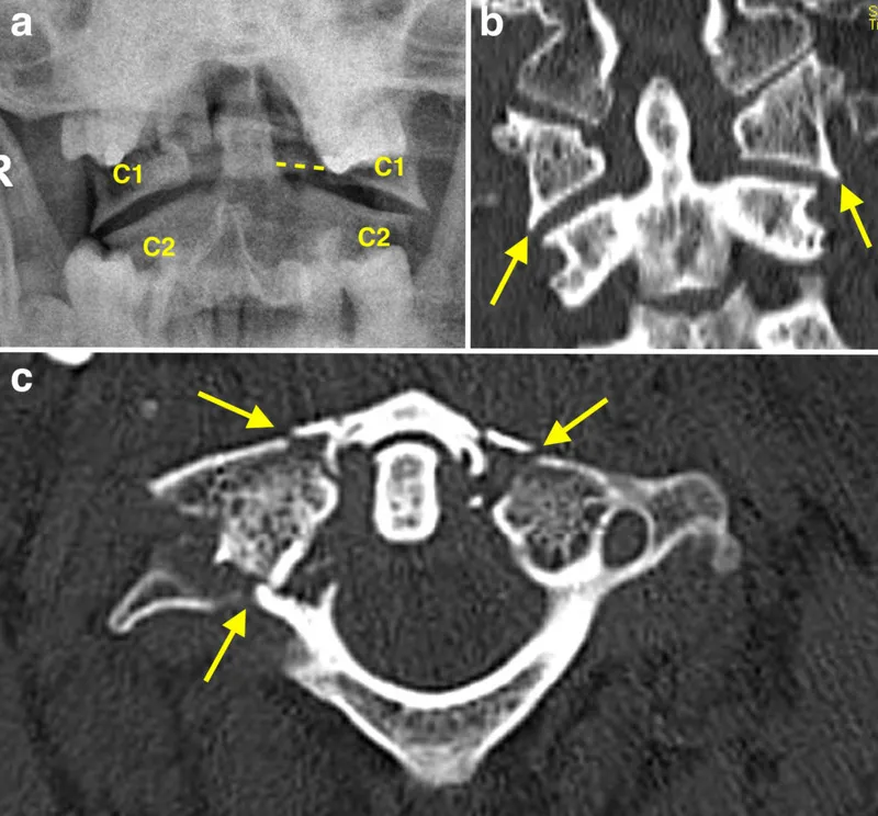 Axial CT C1 Jefferson fracture