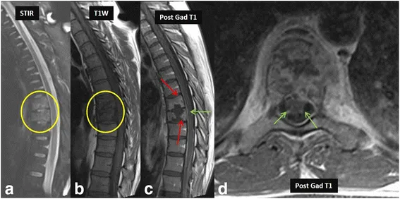 MRI spine: Spondylodiscitis/Pott's spine features