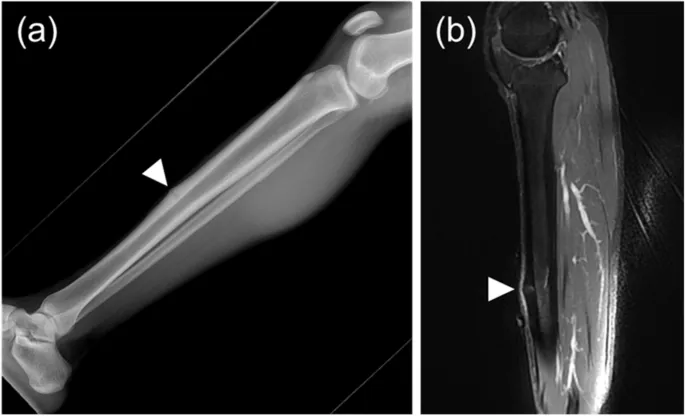 Radiograph and MRI of tibial stress fracture