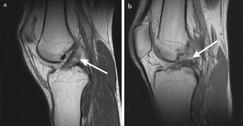 MRI knee: ACL tear and Segond fracture