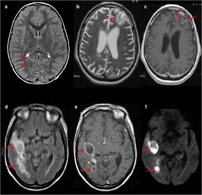 Axial MRI brain pyogenic abscess stages
