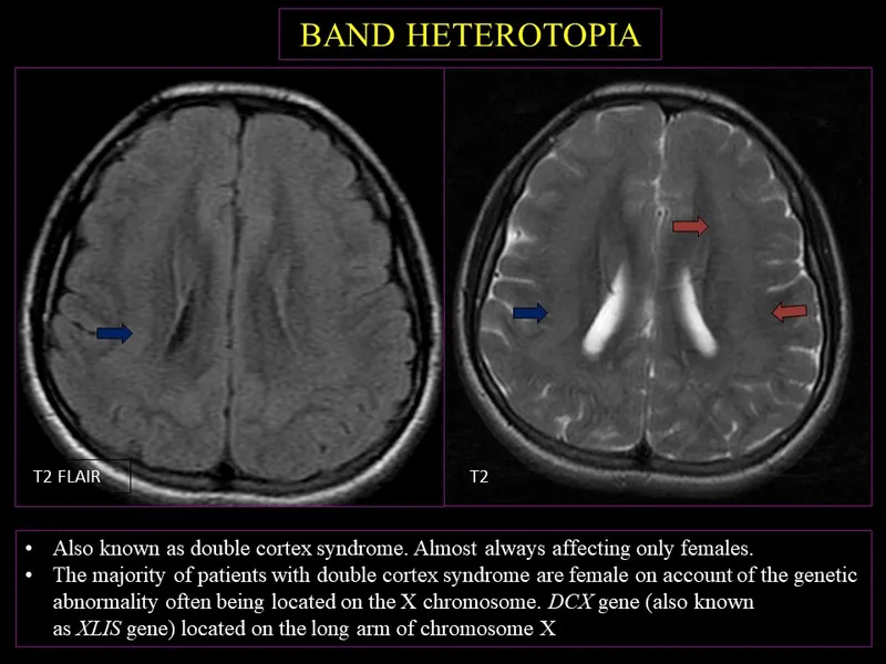 Axial MRI T2/FLAIR showing band heterotopia