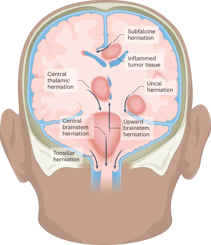 Types of brain herniation