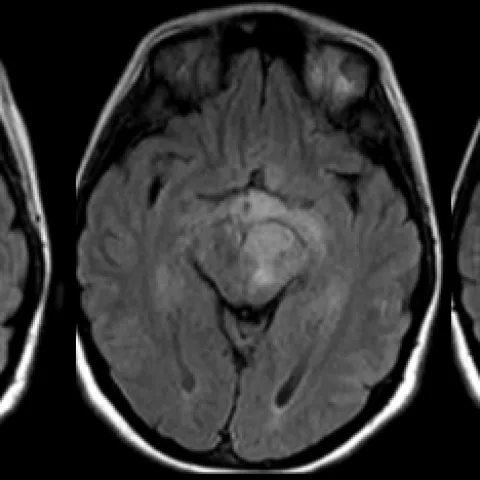 Axial T2 FLAIR MRI of brainstem glioma