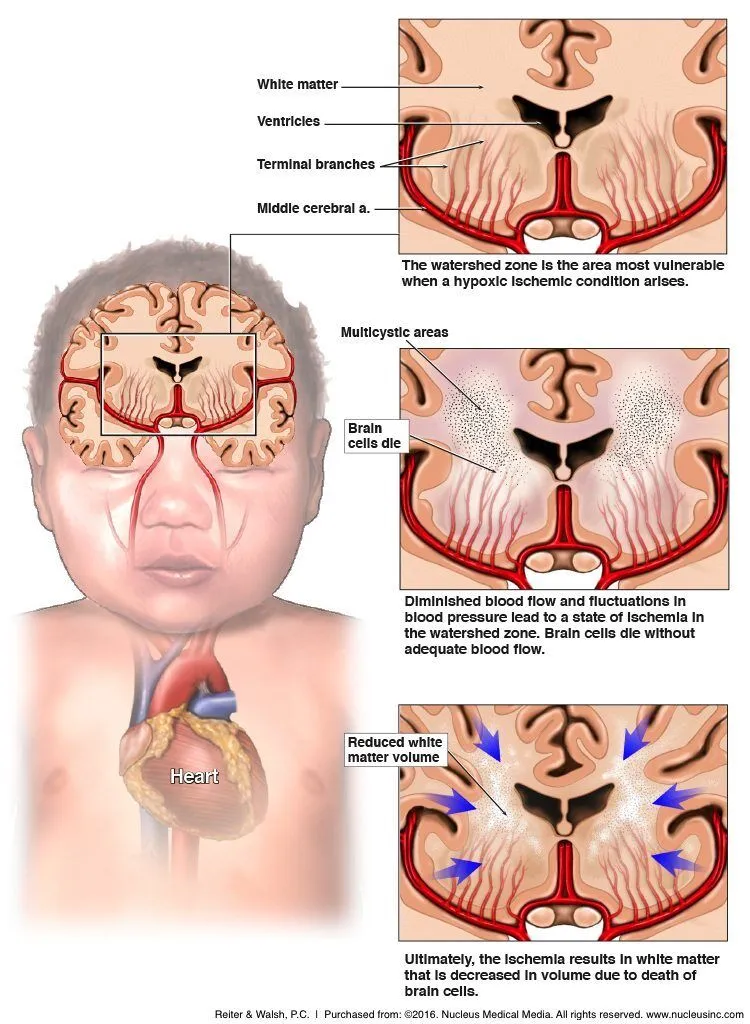 HIE watershed zone injury in infant brain