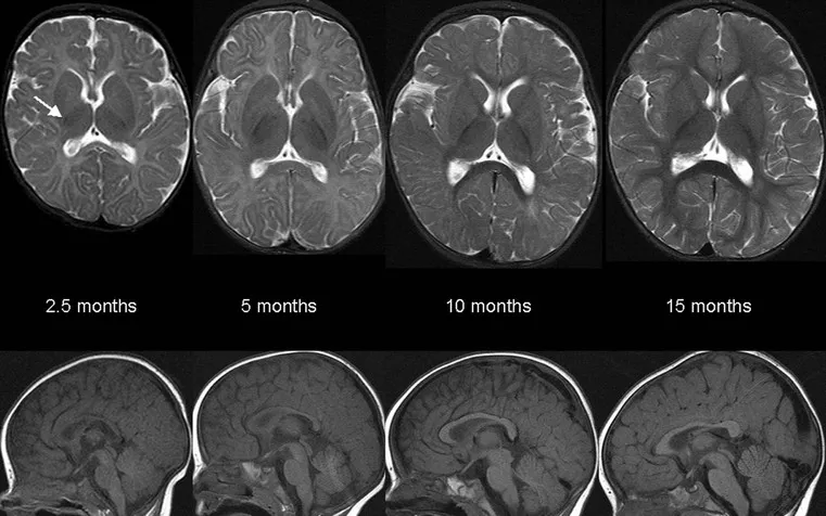 Pediatric brain myelination progression T1 and T2 MRI