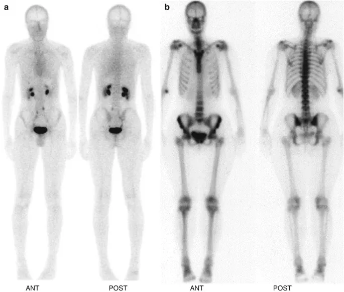 Normal whole body bone scan