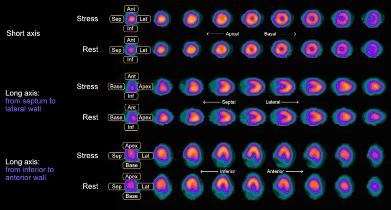 Cardiac SPECT MPI: Stress and Rest Perfusion Patterns