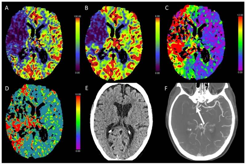 SPECT brain perfusion: acute stroke vs. luxury perfusion