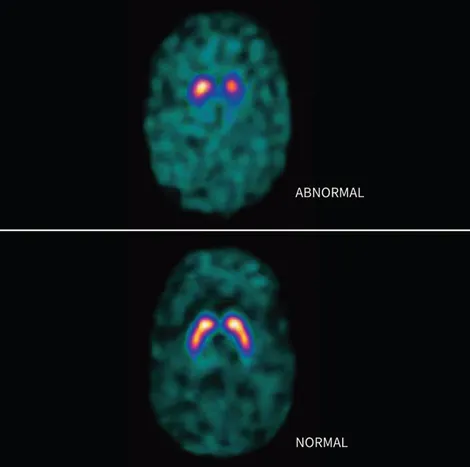 DaTscan SPECT: Normal vs Abnormal Striatal Uptake