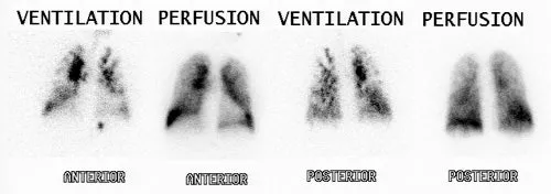 V/Q Scan: Classic PE Mismatch