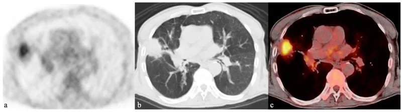 FDG PET/CT of lung cancer