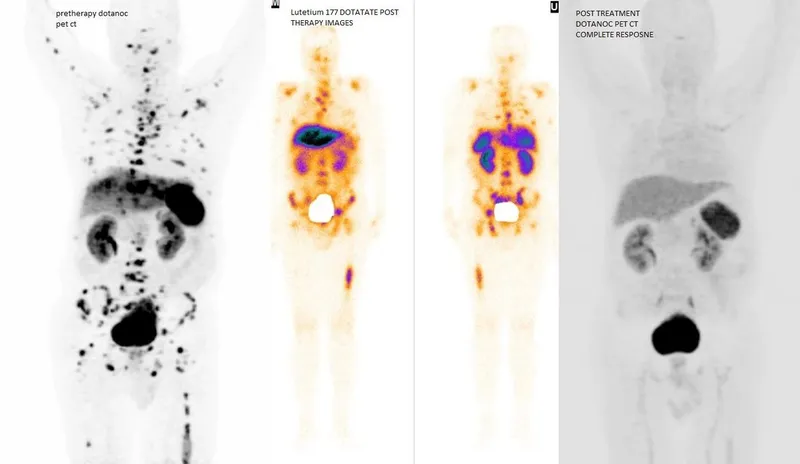 Lu-177 DOTATATE PET CT pre and post therapy