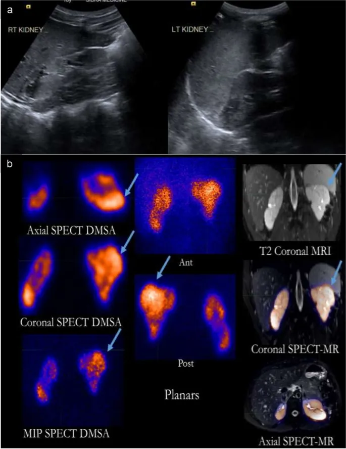 Renal cortical scar on DMSA, MRI, and SPECT-MR