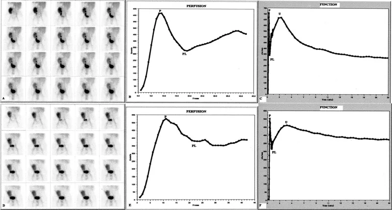 Renal Transplant Scintigraphy: ATN vs. Acute Rejection