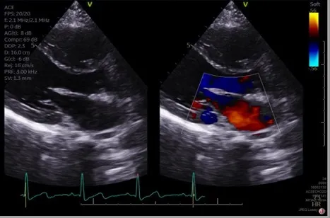 Echocardiogram with color Doppler of VSD shunt